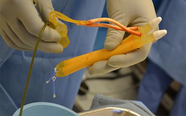 implantes no pênis